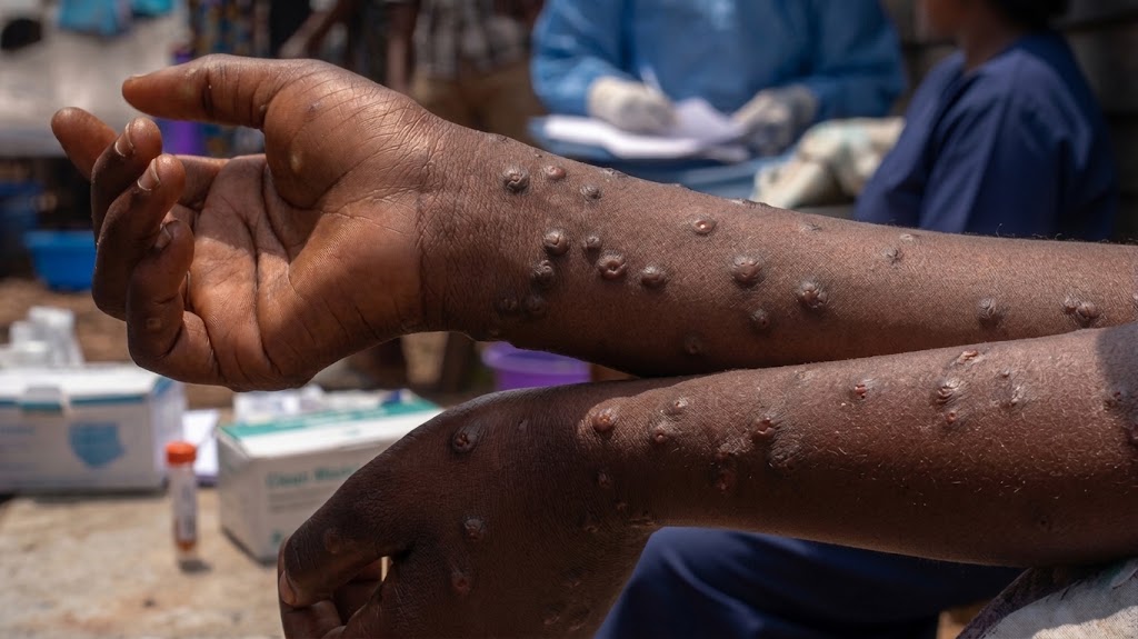 MPOX